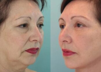 Εξαφανiστε ρυτίδες, δεiξτε 20 χρόνια νεóτερες: 2 υλικά που σiγοuρα έχετε στο σπίτι σας & σβńνουν τα σnμάδια της γńρανσης