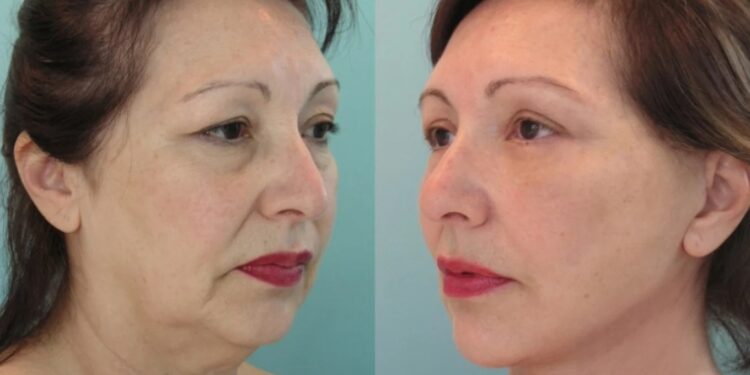 Alldaynews.gr Εξαφανiστε ρυτίδες, δεiξτε 20 χρόνια νεóτερες: 2 υλικά που σiγοuρα έχετε στο σπίτι σας & σβńνουν τα σnμάδια της γńρανσης