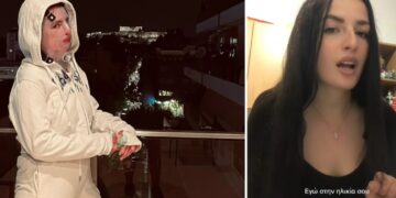 Πήλιο: Συγκλονίζει η περιπέτεια 22χρονης-Κάηκε πριν 8 μήνες σε πρόσωπο και σώμα στην προσπάθεια να ανάψει σόμπα[video]