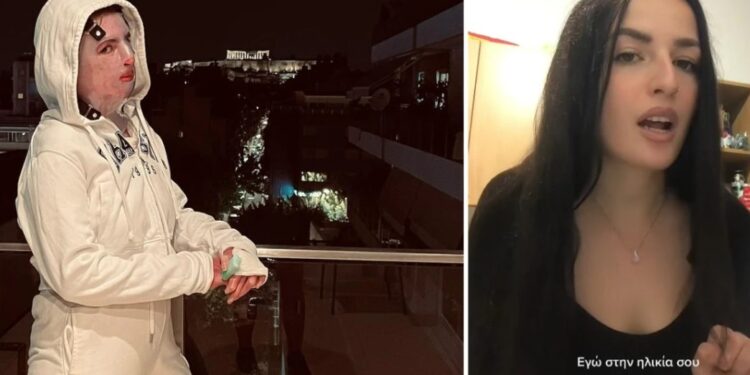 Πήλιο: Συγκλονίζει η περιπέτεια 22χρονης-Κάηκε πριν 8 μήνες σε πρόσωπο και σώμα στην προσπάθεια να ανάψει σόμπα[video]