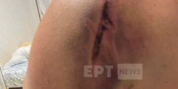 Alldaynews.gr Σοκάρουν τα τραύματα στο σώμα οδηγού λεωφορείου του ΟΑΣΘ – “Με χτυπούσαν στο κεφάλι με γκλομπ” (φωτο, video)