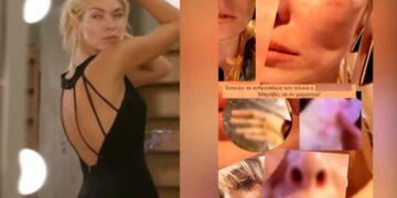 Alldaynews.gr Ξυλοκόπησαν άγρια τη Μικαέλα Φωτιάδη: Ανέβασε σοκαριστικές φωτογραφίες στο Instagram! «Έφαγα πολλές μπουνιές»