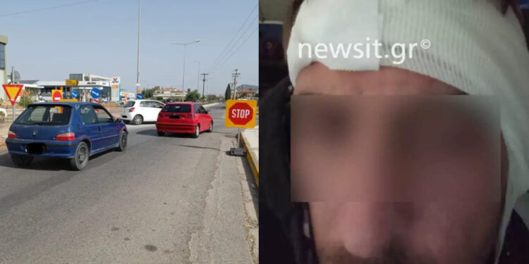 O ντελιβεράς που του δάγκωσαν το αυτί για μια προσπέραση: «Έκοψε κομμάτι, το είδα στο στόμα του και μετά στο έδαφος» (φωτο, video)