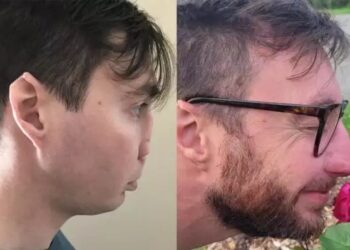 Εκπληκτική μεταμόρφωση άνδρα που είχε χάσει τη μύτη του από επίθεση σκύλου