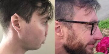 Εκπληκτική μεταμόρφωση άνδρα που είχε χάσει τη μύτη του από επίθεση σκύλου