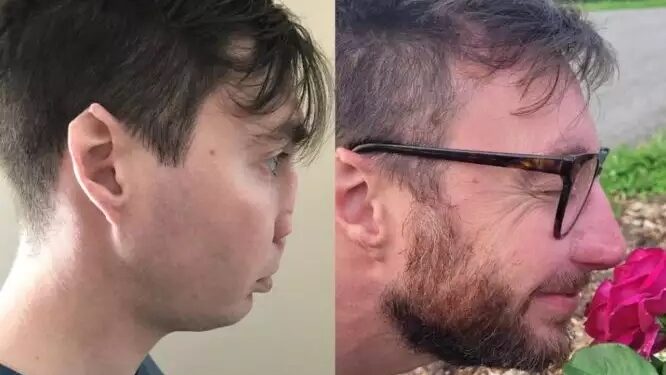 Εκπληκτική μεταμόρφωση άνδρα που είχε χάσει τη μύτη του από επίθεση σκύλου