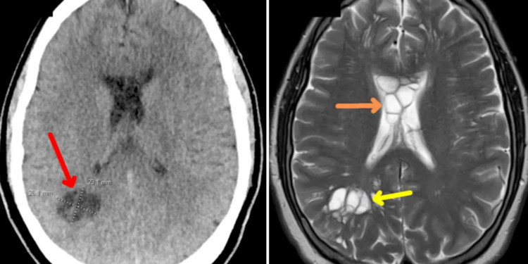 Alldaynews.gr Άφωνοι οι γιατροί: Βρήκαν σκουλήκι που είχε γεννήσει αυγά στον εγκέφαλο άνδρα – Γνωστό αλλαντικό ο «ένοχος»