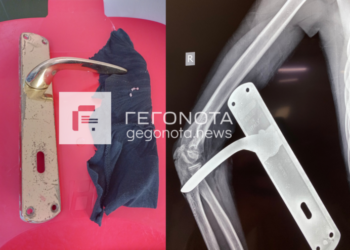 Απίστευτο περιστατικό: Πόμολο καρφώθηκε στο μπράτσο μαθητή δημοτικού και πήγε στο νοσοκομείο σφαδάζοντας (video)