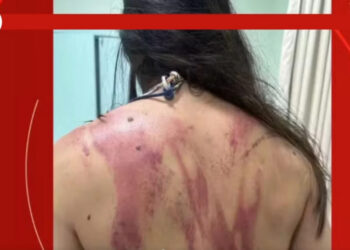 Πατέρας χτύπησε την 33χρονη κόρη του με ματσέτα – Τσακώθηκαν για 165 ευρώ που κόστιζε η επισκευή αυτοκινήτου