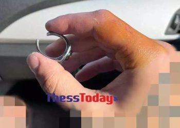Αδιανόητο περιστατικό: Πήγε με πρησμένο δάχτυλο στο νοσοκομείο και φώναξαν ηλεκτρολόγο για να του βγάλει το δαχτυλίδι