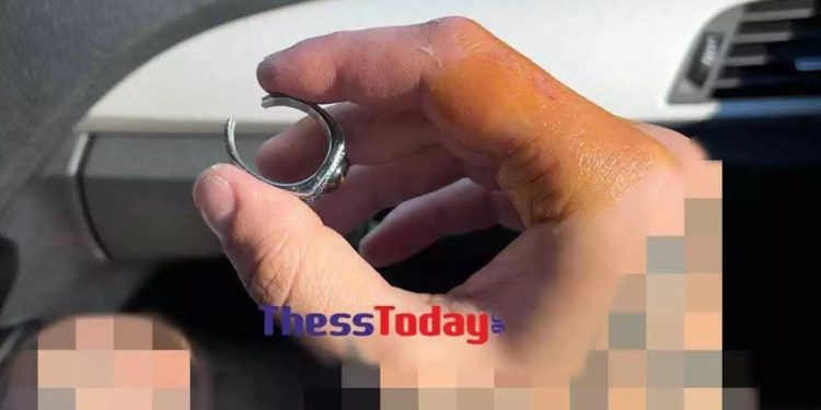 Alldaynews.gr Αδιανόητο περιστατικό: Πήγε με πρησμένο δάχτυλο στο νοσοκομείο και φώναξαν ηλεκτρολόγο για να του βγάλει το δαχτυλίδι