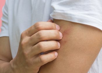 Παγκόσμια ανησυχία για την ευλογιά των πιθήκων: «Καμπανάκι» ΠΟΥ για εξάπλωση κι εκτός Αφρικής – Πώς μεταδίδεται και ποια τα συμπτώματα