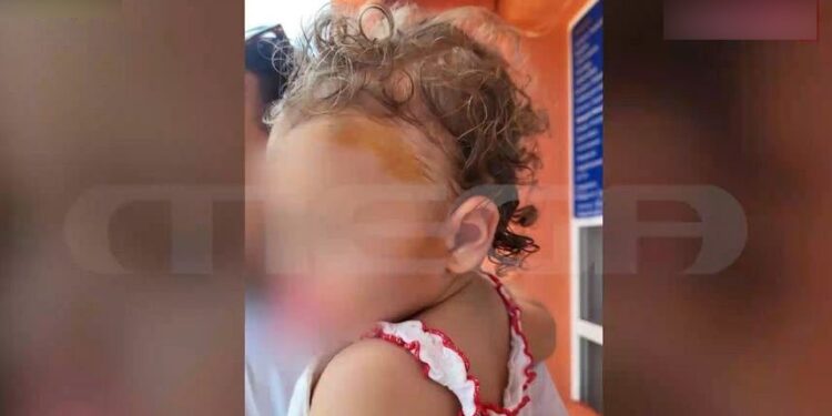 Alldaynews.gr Άγρια επίθεση από αδέσποτο σκύλο: Άρπαξε βρεφάκι 17 μηνών από το κεφάλι – Σε σοκ η μητέρα (video)