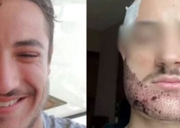 Alldaynews.gr Τραγωδία: 24χρονος που πήγε στην Τουρκία για μεταμόσχευση μαλλιών έβαλε τέλος στη ζωή του – «Έμοιαζε με σκαντζόχοιρο»