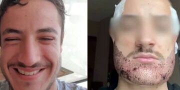 Τραγωδία: 24χρονος που πήγε στην Τουρκία για μεταμόσχευση μαλλιών έβαλε τέλος στη ζωή του – «Έμοιαζε με σκαντζόχοιρο»