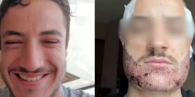 Τραγωδία: 24χρονος που πήγε στην Τουρκία για μεταμόσχευση μαλλιών έβαλε τέλος στη ζωή του – «Έμοιαζε με σκαντζόχοιρο»