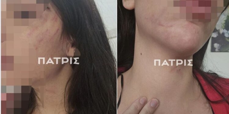 Έδεσσα: 29χρονη πήγε για διακοπές με τον σύντροφο της και έζησε τον απόλυτο εφιάλτη – Την ξυλοκόπησε βάναυσα και την παράτησε στον δρόμο