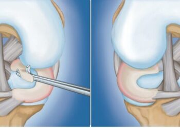 Συρραφή μηνίσκου: Διαδικασία, αποτελέσματα και μετεγχειρητική πορεία για τον μηνίσκο