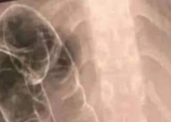 Σοβαρή δυσκοιλιότητα και τοξικό μεγάκολο: Αιτίες και λύσεις