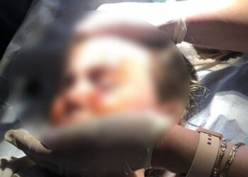 Alldaynews.gr Άγρια επίθεση σκύλου σε κοριτσάκι 4,5 ετών – Τη δάγκωσε στο πρόσωπο – Σκότωσε σκυλάκι πριν λίγες μέρες