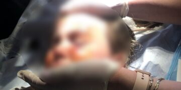 Alldaynews.gr Άγρια επίθεση σκύλου σε κοριτσάκι 4,5 ετών – Τη δάγκωσε στο πρόσωπο – Σκότωσε σκυλάκι πριν λίγες μέρες