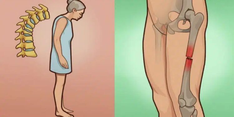 Οστεοπόρωση: Το ελληνικό βότανο που δυναμώνει και προστατεύει τα κόκκαλα