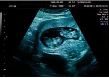 Είμαι έγκυος σε δίδυμα. Ο σύντροφός μου με εγκατέλειψε. Να κάνω έκτpωσn;