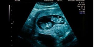 Είμαι έγκυος σε δίδυμα. Ο σύντροφός μου με εγκατέλειψε. Να κάνω έκτpωσn;