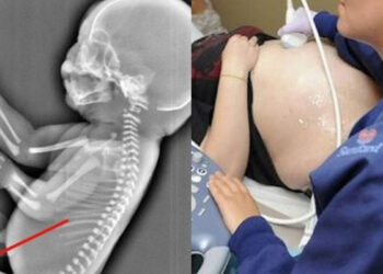 Έγκυος παίρνει την απόφαση να κάνει έκτρωση όταν βλέπει στον υπέρηχο ότι το μωρό της… – Θα σοκαριστείτε