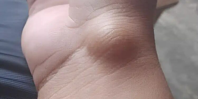 Alldaynews.gr Αυτό το εξόγκωμα μπορεί να εμφανιστεί από κάτι που κάνετε κάθε μέρα