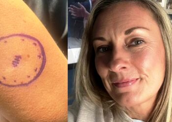 «Είχα μια ελιά τέσσερα χρόνια που εξελίχθηκε σε καρκίνο» – Πώς ήταν ο σπίλος της 46χρονης