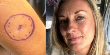 «Είχα μια ελιά τέσσερα χρόνια που εξελίχθηκε σε καρκίνο» – Πώς ήταν ο σπίλος της 46χρονης