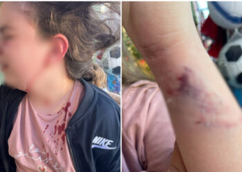 Άγρια επίθεση από σκυλί σε 10χρονη – «Της όρμησε και την έριξε κάτω», λέει η μητέρα της