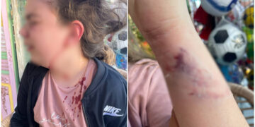 Alldaynews.gr Άγρια επίθεση από σκυλί σε 10χρονη – «Της όρμησε και την έριξε κάτω», λέει η μητέρα της