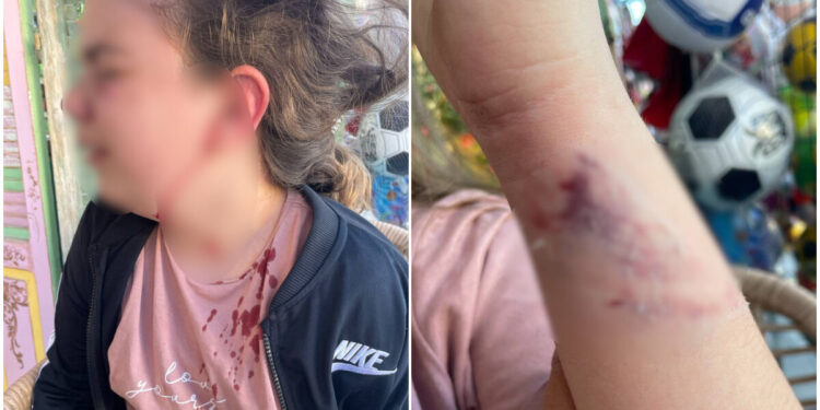 Alldaynews.gr Άγρια επίθεση από σκυλί σε 10χρονη – «Της όρμησε και την έριξε κάτω», λέει η μητέρα της