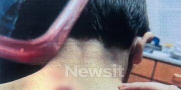 Alldaynews.gr ΝΕΕΣ Φωτογραφίες ΣΟΚ από τα καψίματα με τσιγάρα στα κορμιά των παιδιών στη Λάρισα – «Περίπου 20 λεπτά μας έκαιγε και μας χτυπούσε»