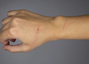 Τραγωδία: Τη γρατζούνισε ένα κουτάβι και δεν έδωσε σημασία, αλλά τελικά αυτό της στοίχισε τη ζωή