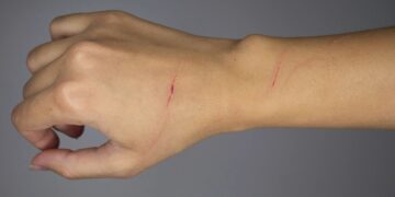 Τραγωδία: Τη γρατζούνισε ένα κουτάβι και δεν έδωσε σημασία, αλλά τελικά αυτό της στοίχισε τη ζωή