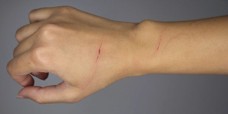 Τραγωδία: Τη γρατζούνισε ένα κουτάβι και δεν έδωσε σημασία, αλλά τελικά αυτό της στοίχισε τη ζωή