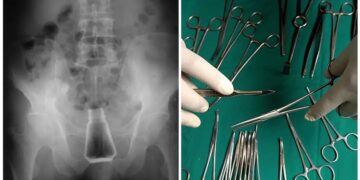 Alldaynews.gr Πήγε στο Νοσοκομείο με ένα μπουκάλι αλάτι στον πρωκτό! Σοκαρισμένοι και οι γιατροί