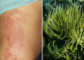 Πώς θα προστατευτείτε από τη θαλάσσια ανεμώνη – Πώς αντιμετωπίζεται το τσίμπημα