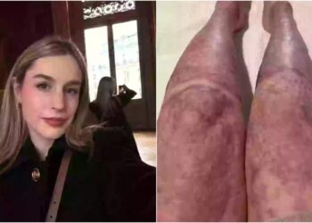 Επέζησε από έκρηξη ηφαιστείου που σκότωσε 22 ανθρώπους: Η εμφάνιση της 5 χρόνια μετά… σοκάρει (video)