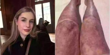 Επέζησε από έκρηξη ηφαιστείου που σκότωσε 22 ανθρώπους: Η εμφάνιση της 5 χρόνια μετά… σοκάρει (video)