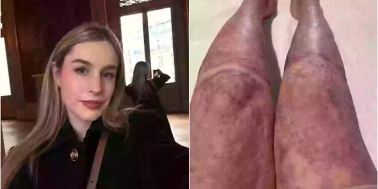 Επέζησε από έκρηξη ηφαιστείου που σκότωσε 22 ανθρώπους: Η εμφάνιση της 5 χρόνια μετά… σοκάρει (video)