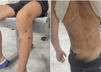 Στο νοσοκομείο 7χρονος μετά από επίθεση σκυλιών – «Παραλίγο να το κατασπαράξουν» λέει η μητέρα του