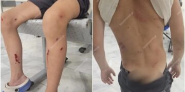 Alldaynews.gr Στο νοσοκομείο 7χρονος μετά από επίθεση σκυλιών – «Παραλίγο να το κατασπαράξουν» λέει η μητέρα του
