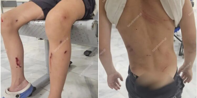 Alldaynews.gr Στο νοσοκομείο 7χρονος μετά από επίθεση σκυλιών – «Παραλίγο να το κατασπαράξουν» λέει η μητέρα του