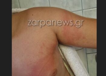 11χρονος τσιμπήθηκε από θαλάσσια ανεμώνη και γέμισε με εξανθήματα