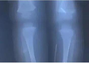 Σοκ Τρυπούσε με βελόνες το κορμί του μωρού της για τον αδιανόητο λόγο