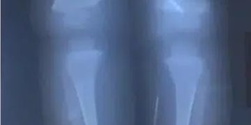 Alldaynews.gr Σοκ Τρυπούσε με βελόνες το κορμί του μωρού της για τον αδιανόητο λόγο